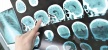 Hampir Mencapai 1,8 KG, Dokter di India Berhasil Angkat Tumor Terbesar di Dunia